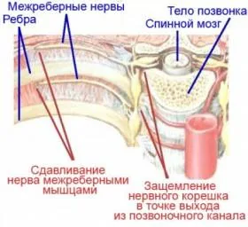 Как не спутать болезни сердца с межрёберной невралгией