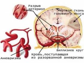 Спасти жизнь может распознавание симптомов инсульта