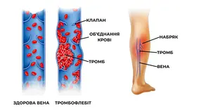 Прості способи знизити ризик – як зупинити утворення тромбів