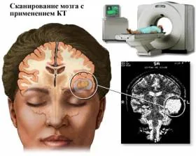 Медики: мигрень связана с психическими расстройствами