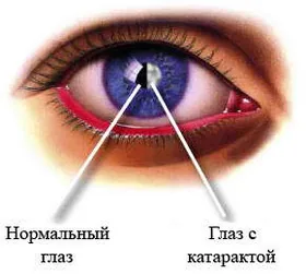 Катаракта: причины и лечение
